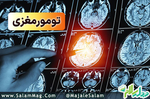 تومور مغزی چیست